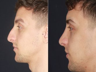 Rinoplastia antes y después - 876933