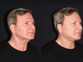 Lifting antes y después - 876934