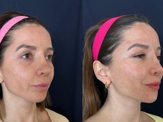 Rejuvenecimiento facial antes y después - 879091