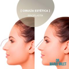Rinoplastia - Dr. Mario Eduardo Milet