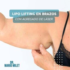 Lipo Lifting en Brazos - Dr. Mario Eduardo Milet