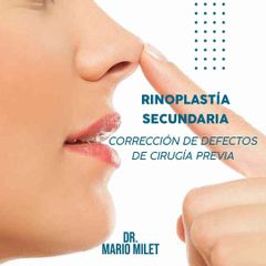 Rinoplastía Secundaria - Dr. Mario Eduardo Milet