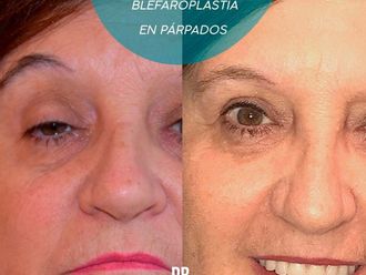 Blefaroplastia antes y después - 877184