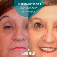 Blefaroplastia - Dr. Mario Eduardo Milet