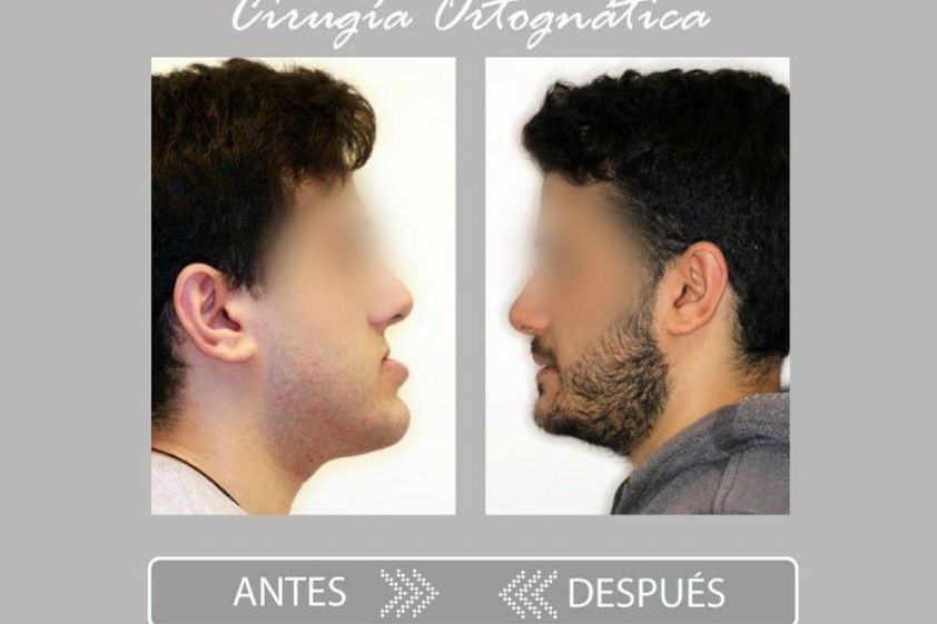 Cirugía maxilofacial antes y después - 775780