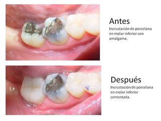 Prótesis dentales - 548549