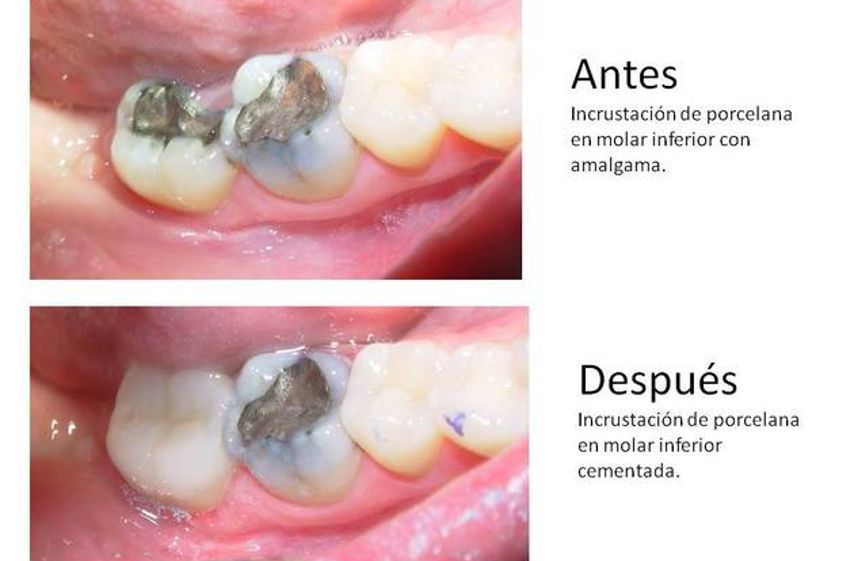 Prótesis dentales antes y después - 548549