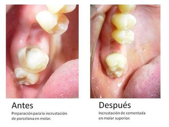 Prótesis dentales - 548552