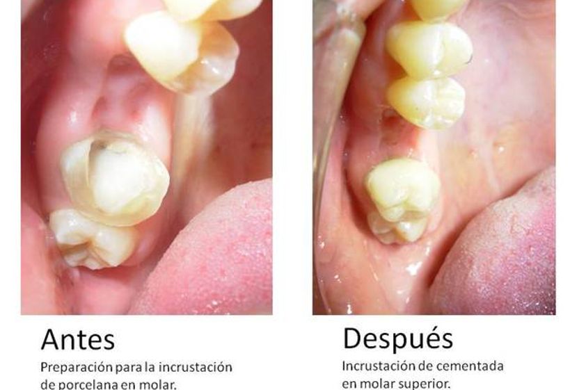 Prótesis dentales antes y después - 548552