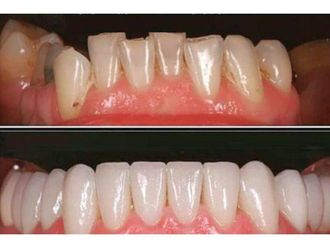 Carillas de porcelana - 642594