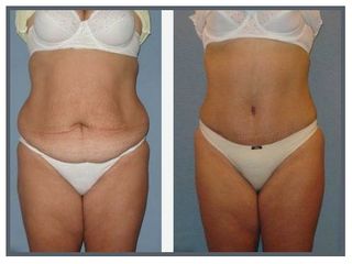 Abdominoplastia