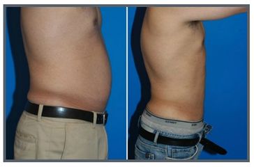 Lipoescultura