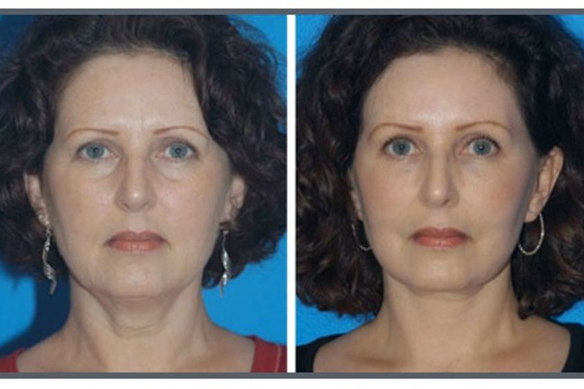 Rejuvenecimiento facial antes y después - 280460