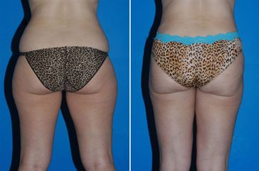 Lipolaser espalda, flancos, caderas y piernas