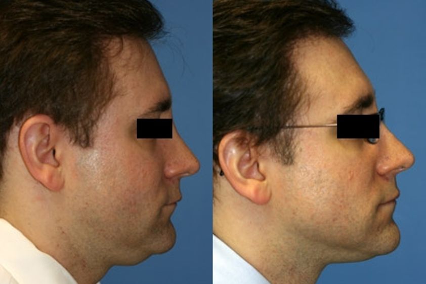 Cirugía maxilofacial antes y después - 349622