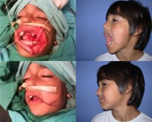 Reconstrucción post trauma facial niños