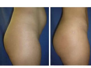 Gluteoplastia