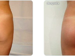 Antes y despues de gluteoplastia