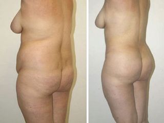 Antes y despues de abdominoplastia