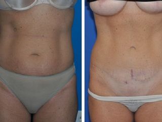Antes y despues de abdominoplastia