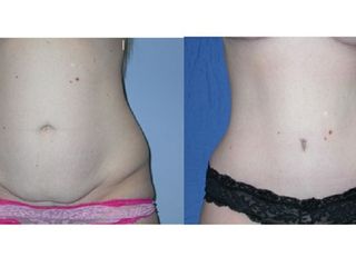 Antes y despues de abdominoplastia