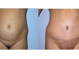 Antes y despues de abdominoplastia