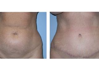 Antes y despues de abdominoplastia