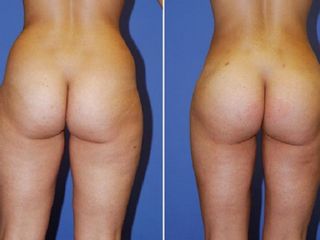 Antes y despues de Aumento de gluteos