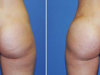 Antes y despues de Aumento de gluteos