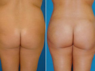 Antes y despues de Aumento de gluteos