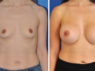 Antes y despues de aumento mamario