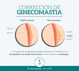 La ginecomastia es el agrandamiento del tejido graso y/glandular de los pectorales en hombres.