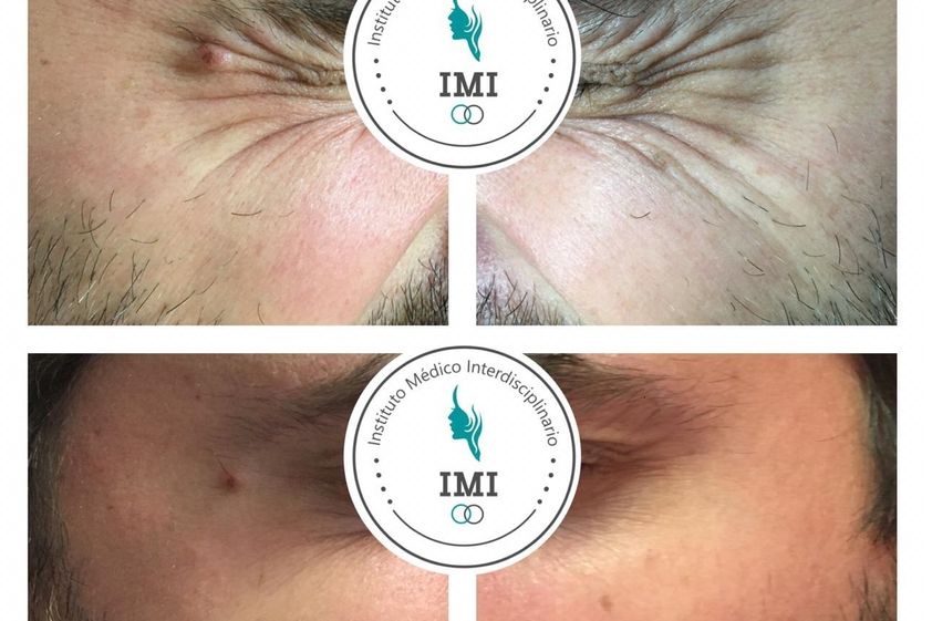 Botox antes y después - 738179