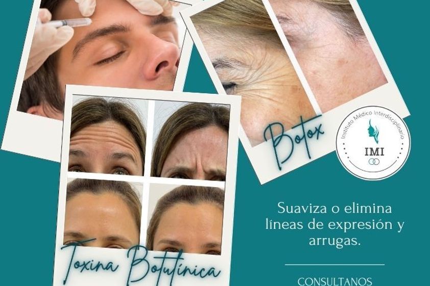 Botox antes y después - 842229