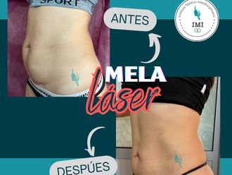Liposucción antes y después - 880093