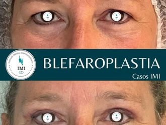 Blefaroplastia antes y después - 880094