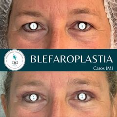 Blefaroplastia - Dr. Jose Luis Ava