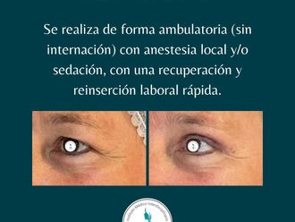 Blefaroplastia antes y después - 880095