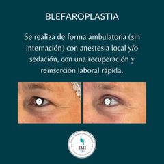 Blefaroplastia - Dr. Jose Luis Ava