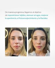 Rejuvenecimiento Facial (Sculptra) - Escobar Aesthetic Clinic