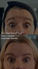 Botox - Escobar Aesthetic Clinic