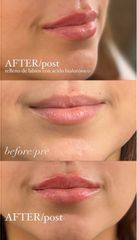 Rellenos de labios con Acido Hialuronico - Escobar Aesthetic Clinic