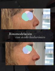 Rinomodelación con Acido Hialuronico - Escobar Aesthetic Clinic1