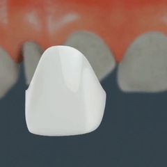 Carillas dentales