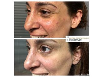 Peeling antes y después - 637690