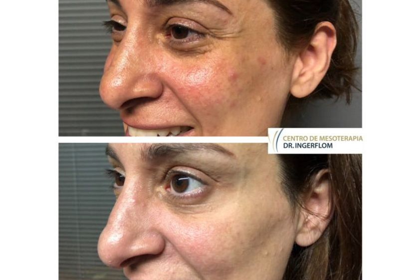 Peeling antes y después - 637690
