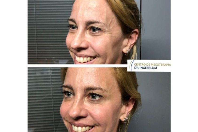 Peeling antes y después - 637691