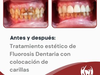 Carillas dentales - 851915