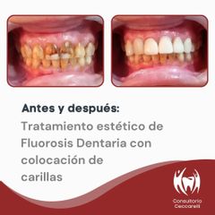 Tratamiento estético de Fluorosis Dentaria