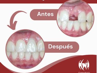 Implantes dentales - 853719